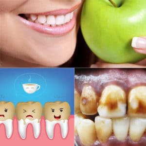 como quitar las manchas de los dientes