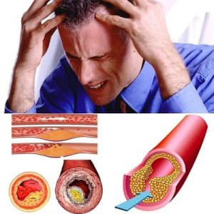 aterosclerosis sintomas